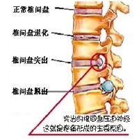 腰椎间盘突出症的基本治疗方法图1