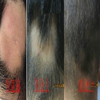 脂溢性脱发，秃发、遗传秃发图1